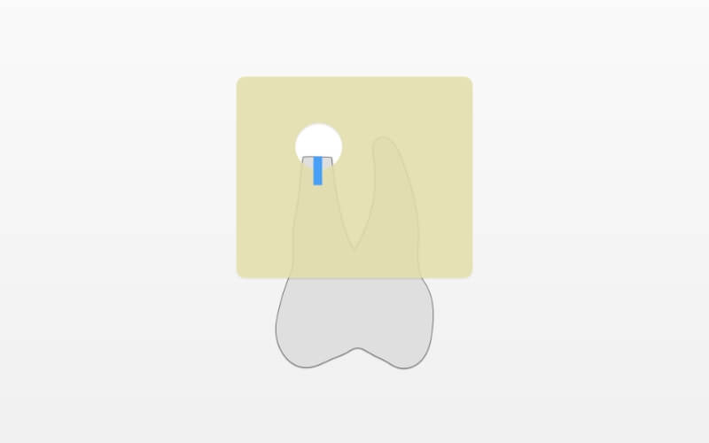 歯根端切除術図