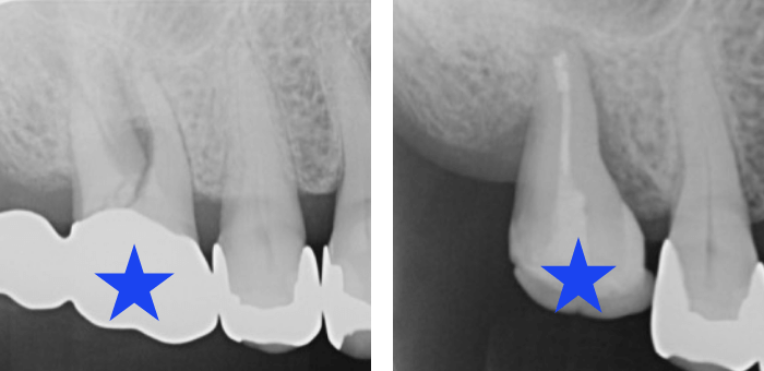レントゲン写真
