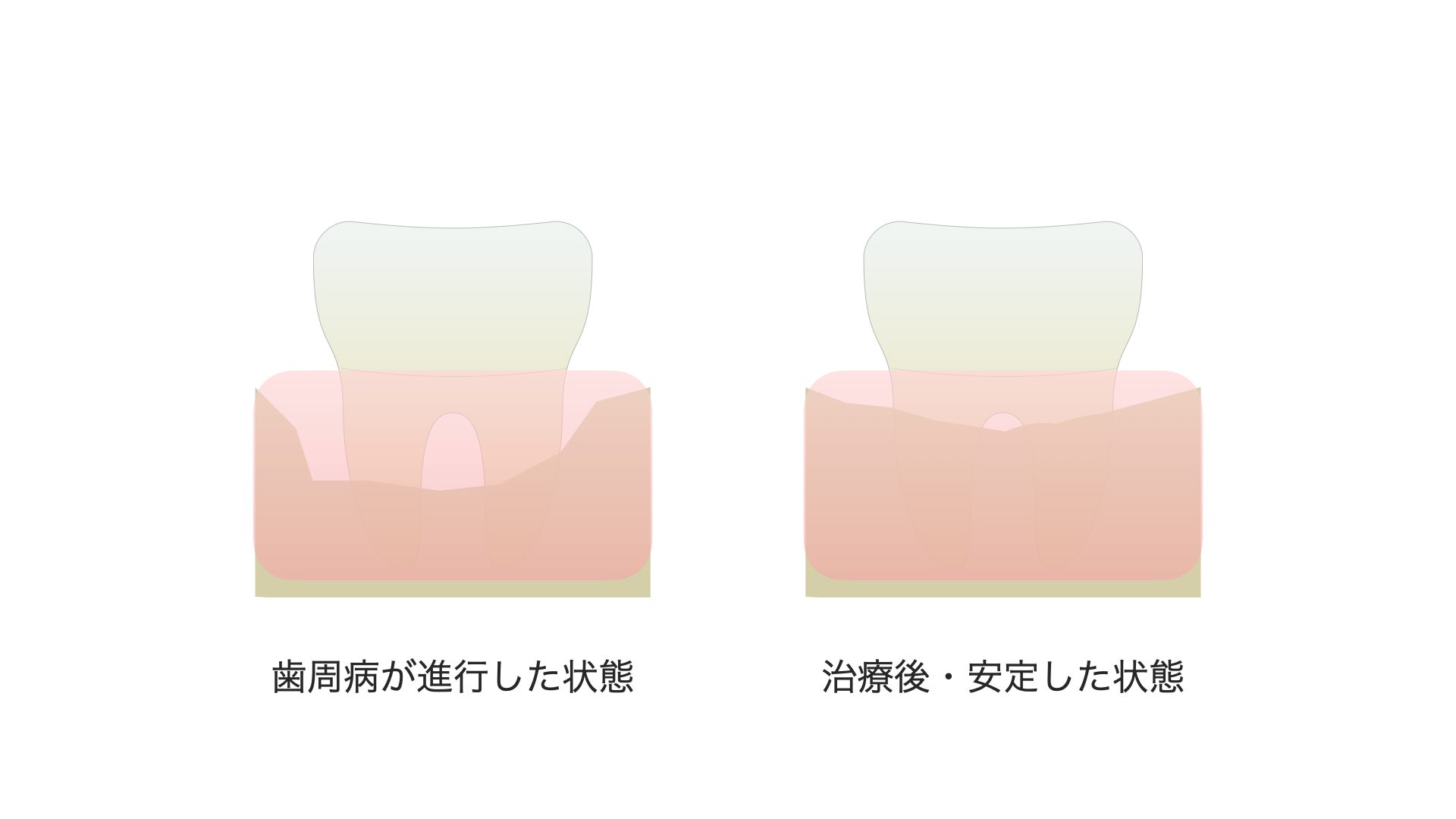 左：歯周病が進行した状態　右：治療後・安定した状態
