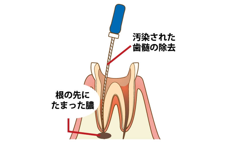 根管治療の説明画