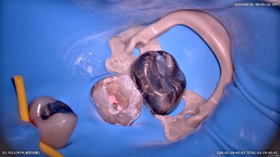 ラバーダム防湿