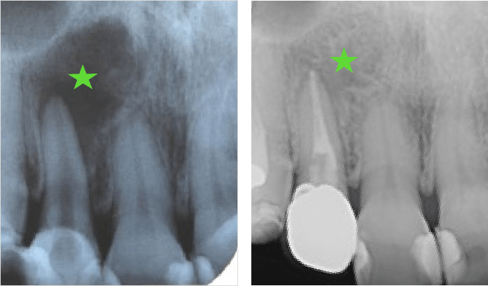 レントゲン写真
