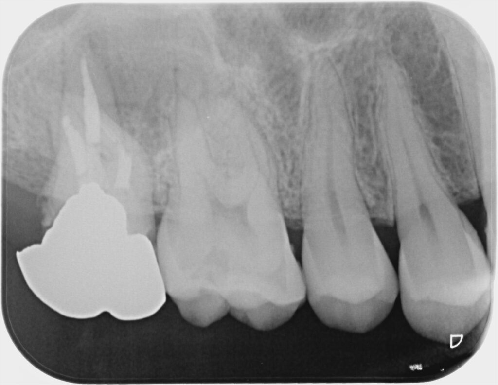 術前レントゲン写真：不適合な修復物、湾曲のある根を認める