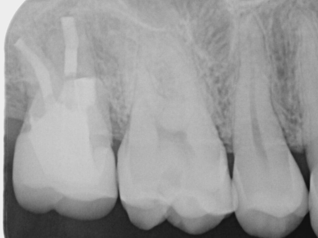 術後経過観察時のレントゲン写真