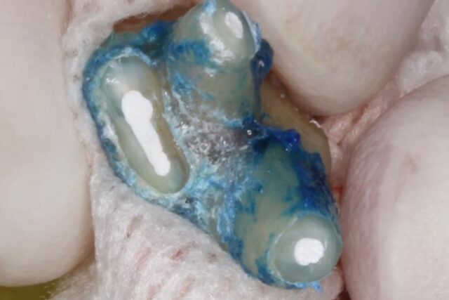 意図的再植：再植前