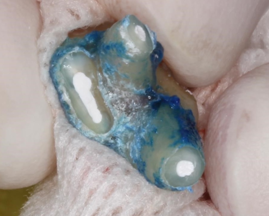 意図的再植：抜歯、根切除、逆根管可動形成、MTAにて封鎖を行なった