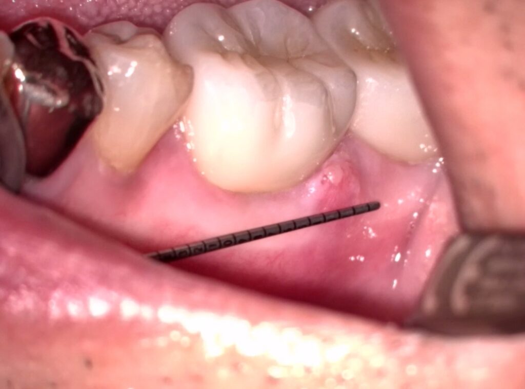 サイナストラクトを認める歯
秋山勝彦先生考案のPeriodontal Micro Probeにて計測