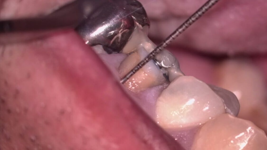 限局矯正（矯正的挺出）装置撤去時、頰側３ミリのフェルールを確保した