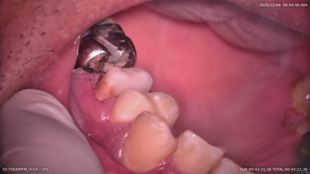 コアビルドアップ（ファイバーポスト）