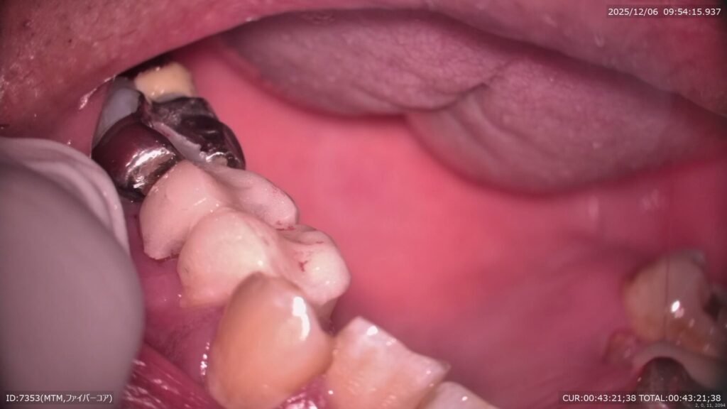 テンポラリークラウン製作