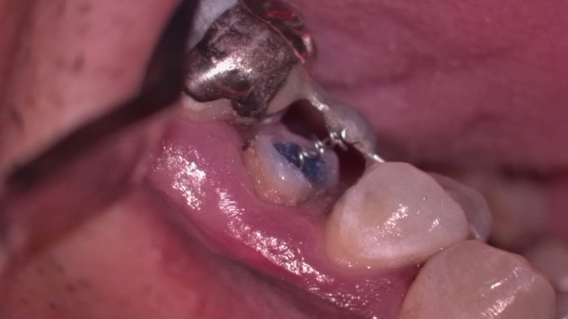 限局矯正（矯正的挺出）装置装着時