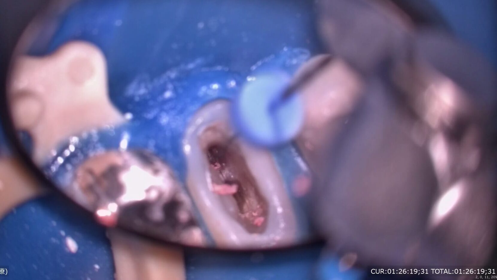 精密根管治療術中、ラバーダム、新品の器具使用