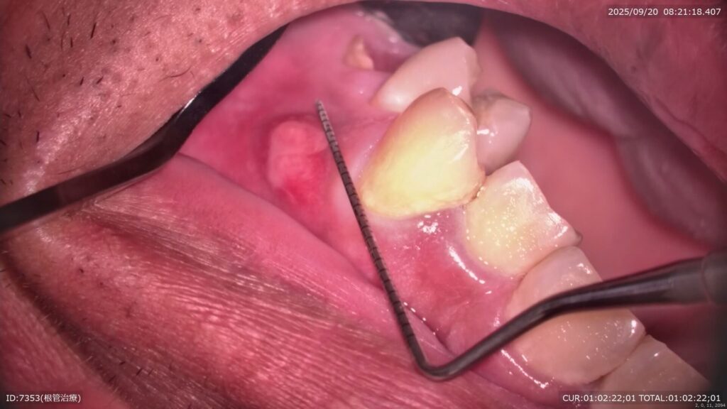 歯肉にサイナストラクト（膿の出口）を認める