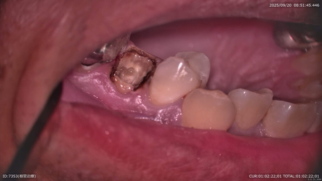 術前の状態、フェルール（歯肉の上の歯質がほぼ無い）