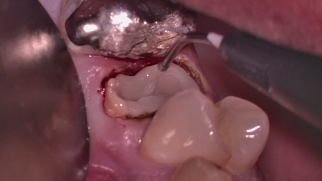 精密根管治療前に隔壁を製作した（ラバーダム防湿、感染予防）