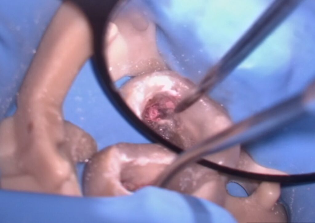 マイクロスコープで修復物を除去時の画像