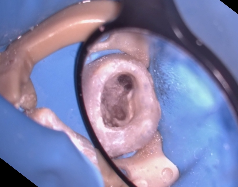 MB2の発見、拡大・清掃