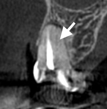 CBCTによるMB根の断層。口蓋側に未処置の根管(MB2)を認める