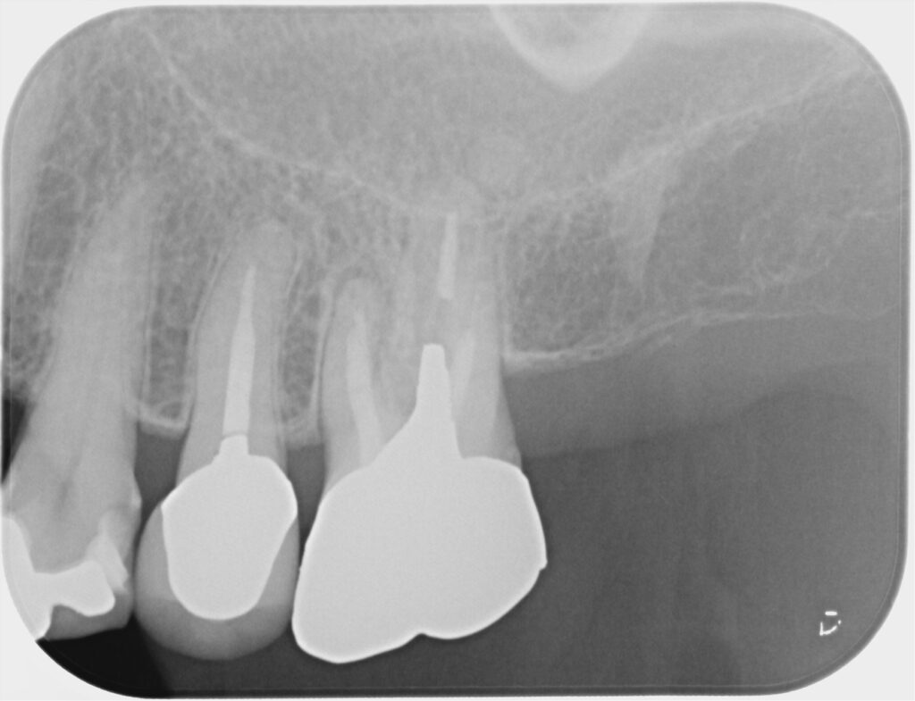 術前レントゲン:MB根の根尖に透過像を認める