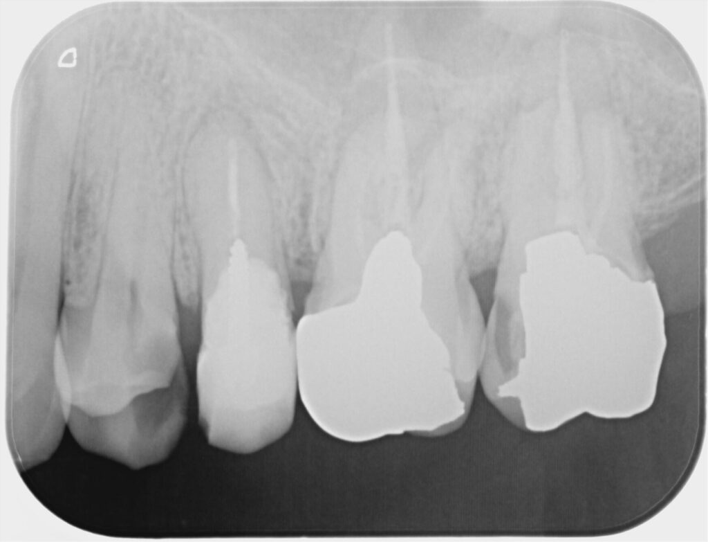 精密根管治療術前の状態、根の先に病変と大きな修復物を認める