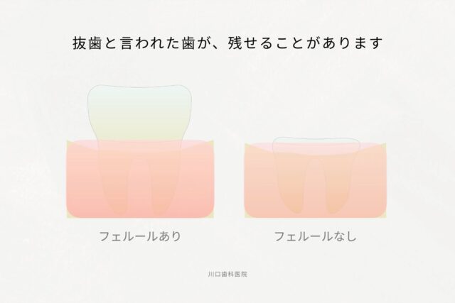 抜歯と言われた歯が、残せることがあります。1〜2mmのフェルールが、歯を守るカギです。