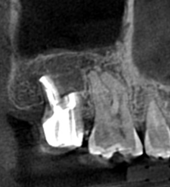 術後CT：病変の縮小、上顎洞底の里モデリングを認める。