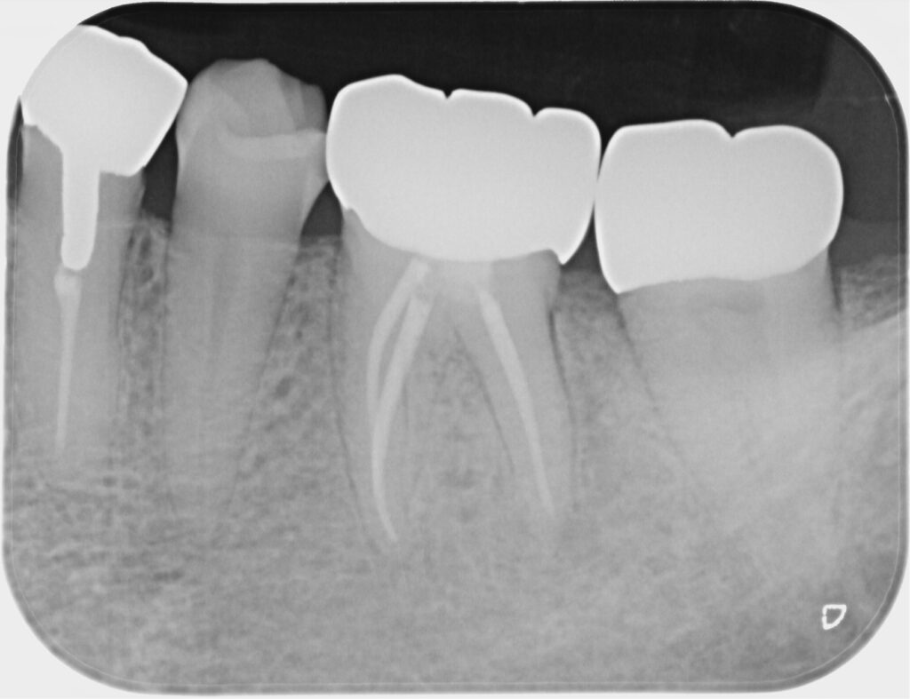 術後のレントゲン写真
病変の改善傾向を確認