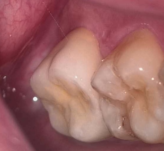 セラミッククラウンを装着した口腔内写真（顕微鏡で撮影）