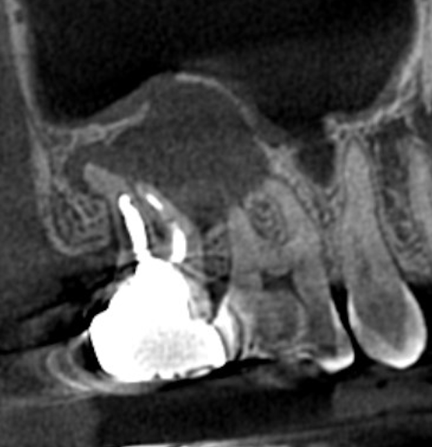 術前CT：大きな透過像、上顎洞に達する病変