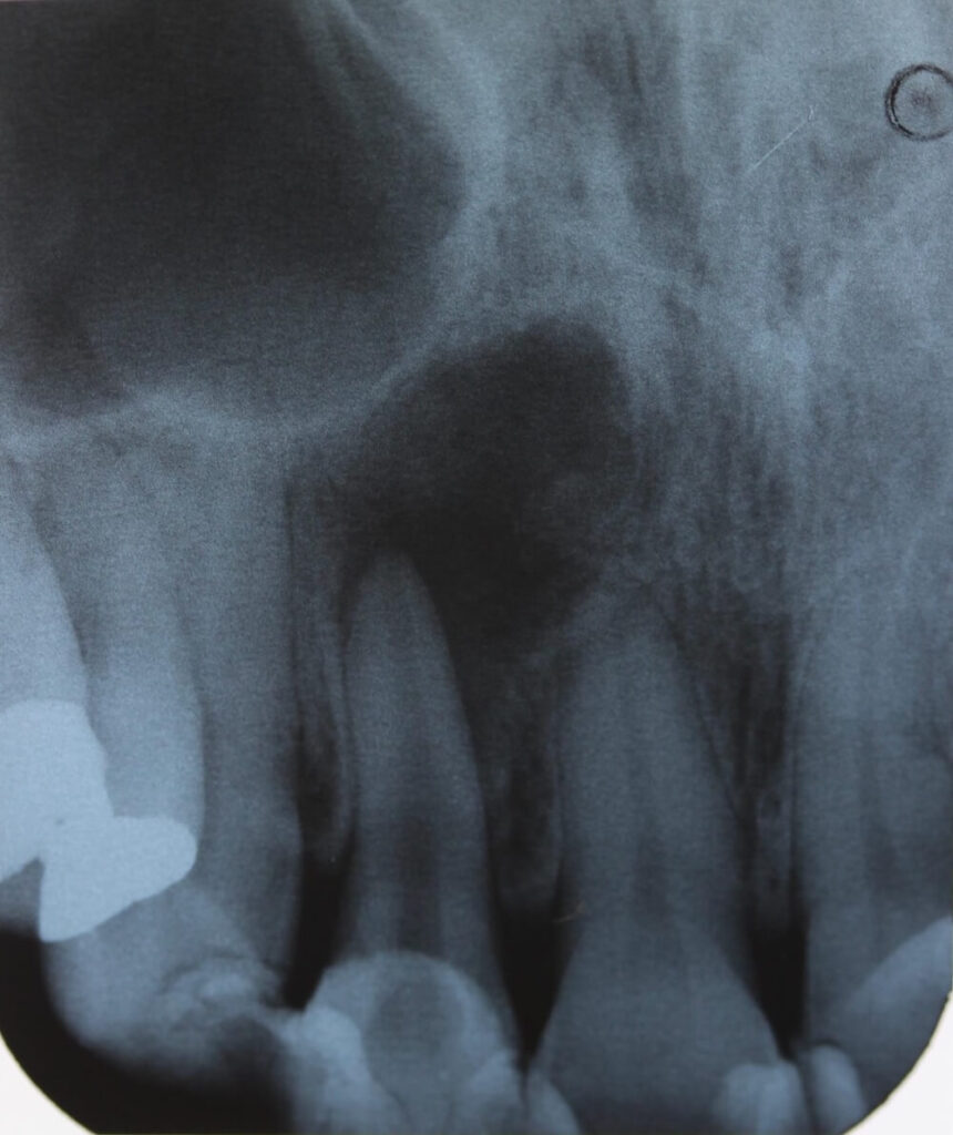 精密根管治療、術前のレントゲン