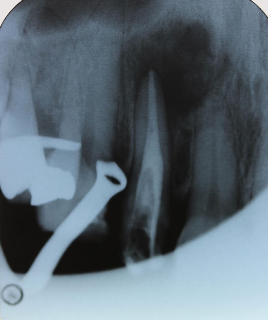精密根管治療後レントゲン（根管充填後）