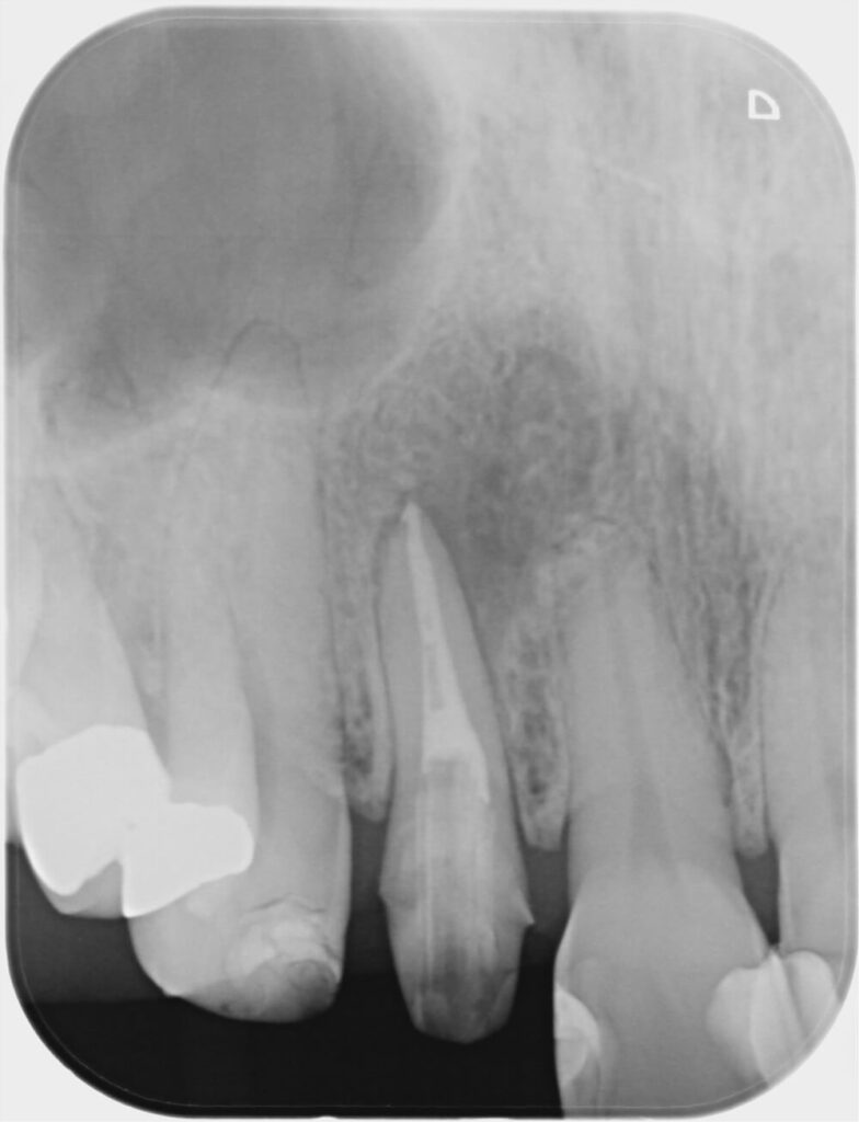 精密根管治療、ファイバーコア後経過のレントゲン