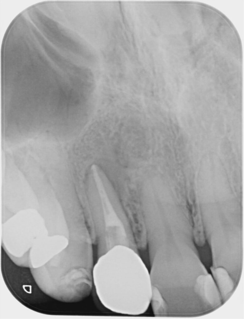 精密根管治療術後１年６ヶ月後のレントゲン