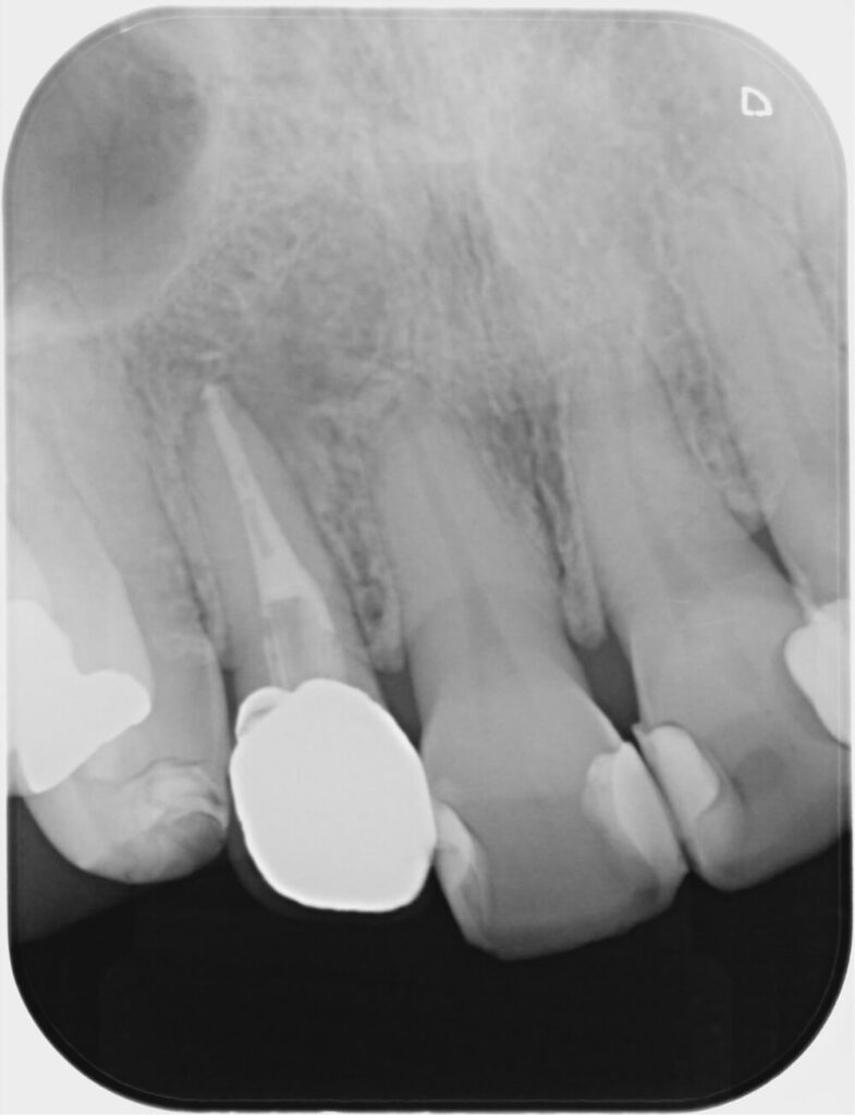 精密根管治療後術後２年のレントゲン（最終補綴後）